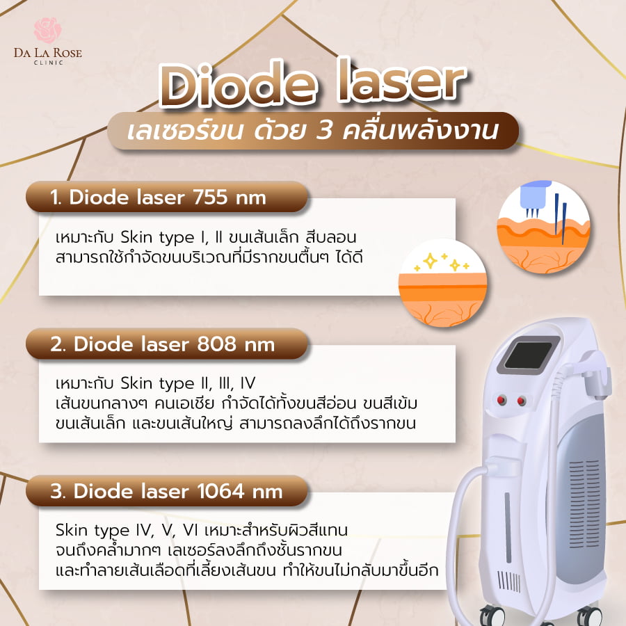 เลเซอร์ขน