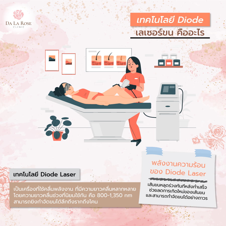 เลเซอร์ขน