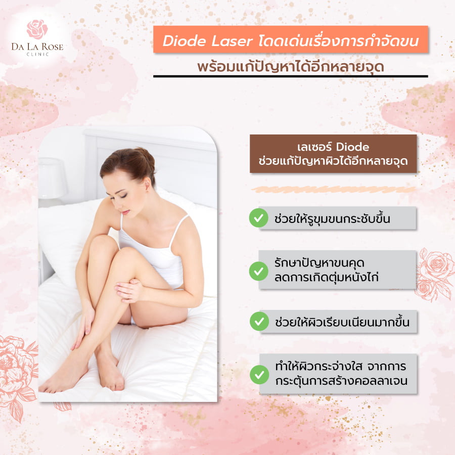 เลเซอร์ขน