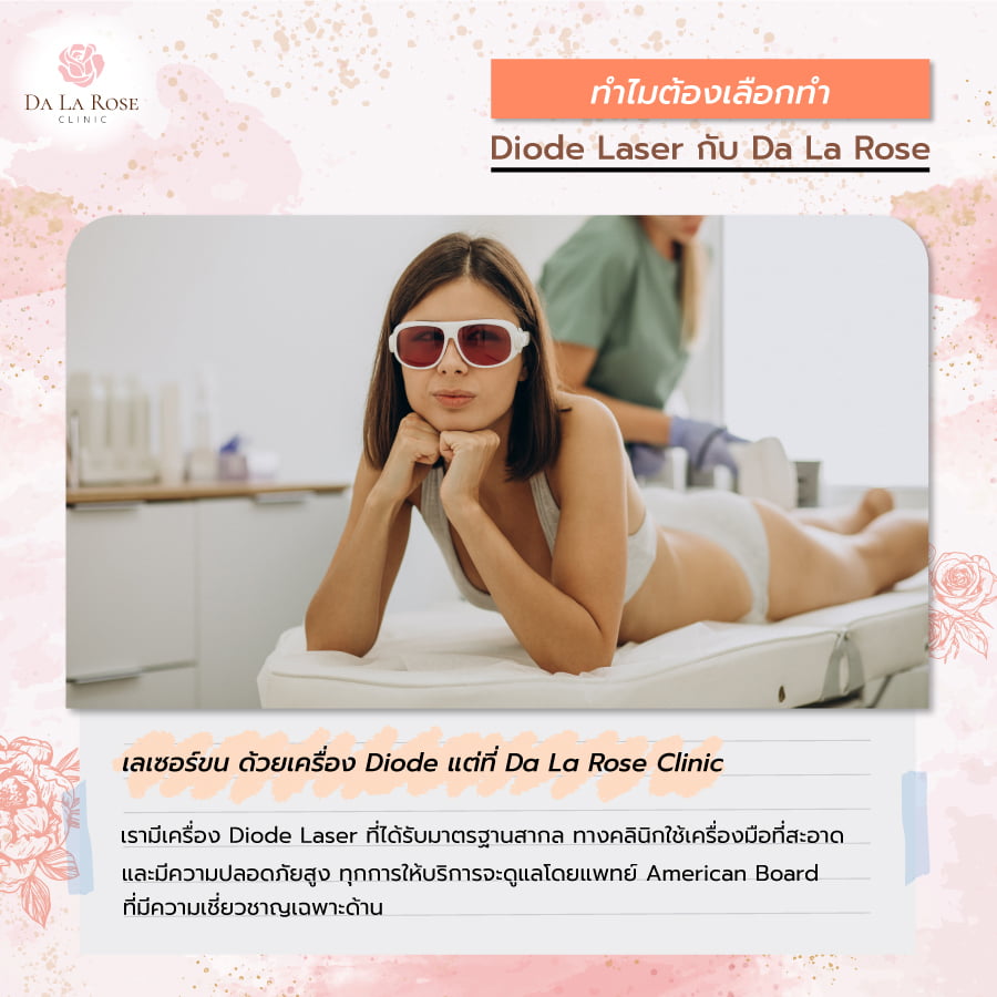 เลเซอร์ขน